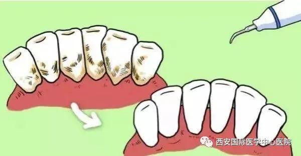 【科普】牙齒上的黃斑好難看，三招告訴你如何預(yù)防氟斑牙