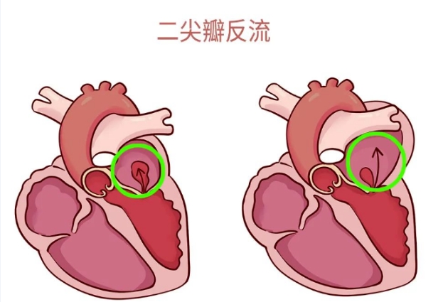 體檢報告里的心臟瓣膜反流，你讀懂了嗎？